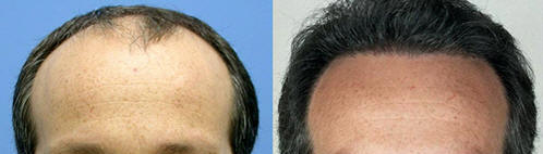 transplante de pelo Bogota Colombia